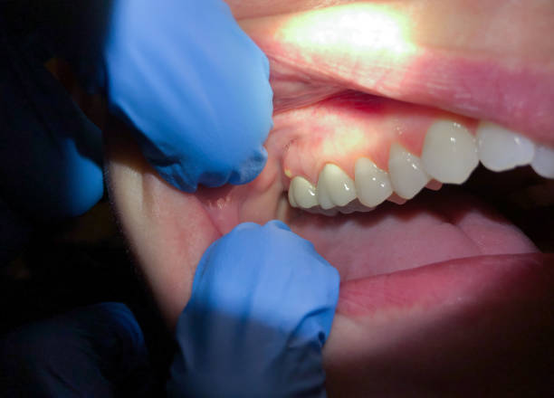 Best Emergency Treatment for Dental Infections or Abscesses in Nooksack, WA